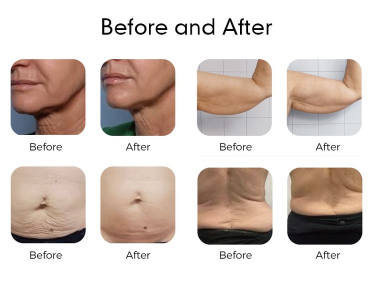 microwave body contouring machine microwave body contouring machine